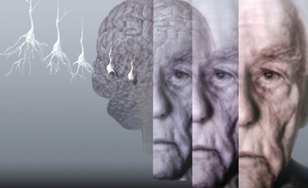 Биолози откриха нови свидетелства че болестта на Алцхаймер може да