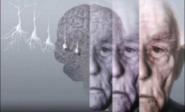 Болестта Алцхаймер може да бъде заразна