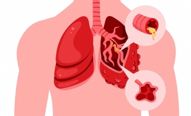Белодробните заболявания се обострят през есенно-зимния сезон